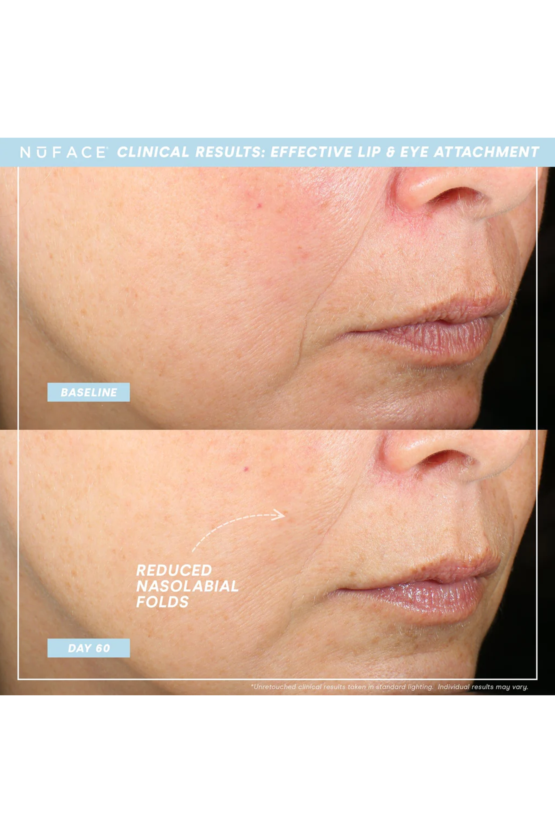 جهاز ترينيتي نوفيس وملحقات لمنطقتي الشفاه والعين