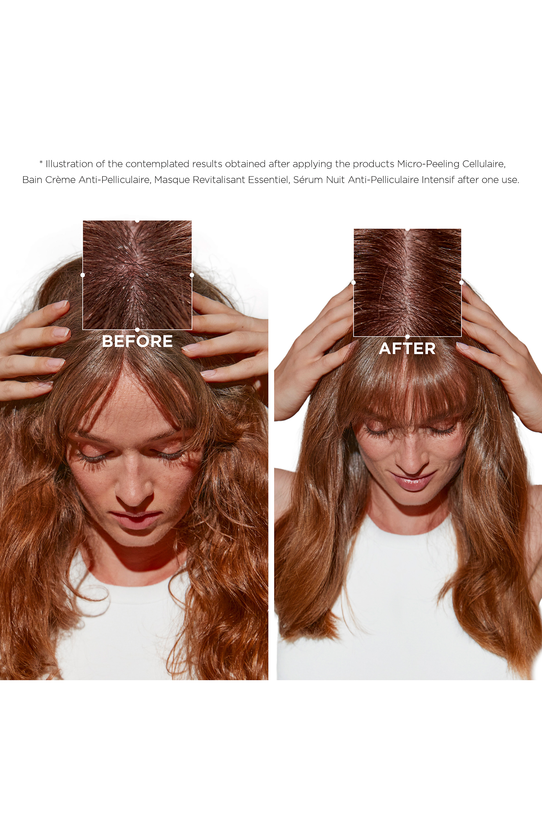 قناع سيمبيوس انتانس مضاد للقشرة