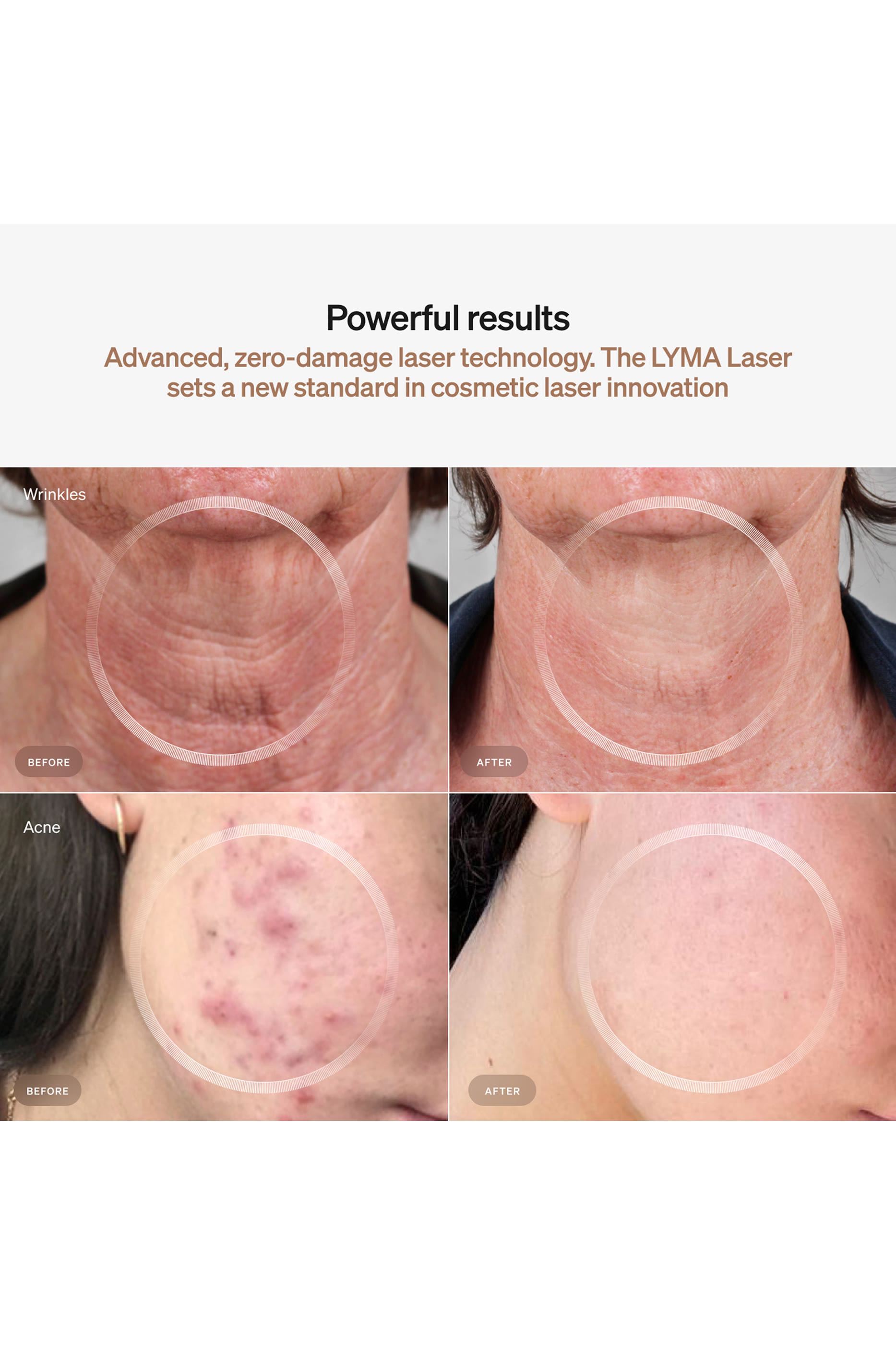 مجموعة بتقنية الليزر للمبتدئين